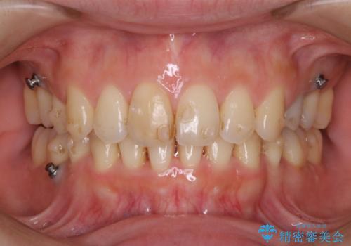 インビザライン中の着色を落とすの治療前