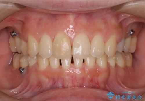 インビザライン中の着色を落とすの治療後