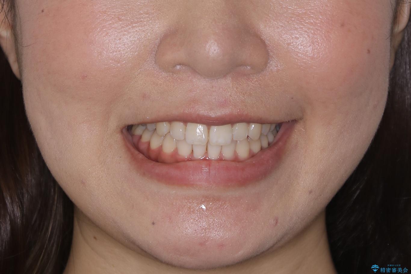 【非抜歯】部分矯正でも治る 前歯の反対咬合の治療後(顔貌)