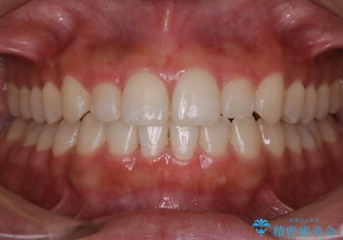 【非抜歯】部分矯正でも治る 前歯の反対咬合の症例 治療後