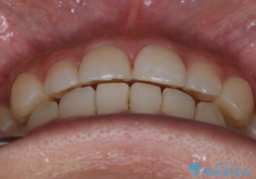 【非抜歯】部分矯正でも治る 前歯の反対咬合の治療後