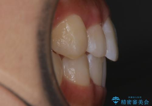 【非抜歯】部分矯正でも治る 前歯の反対咬合の治療後