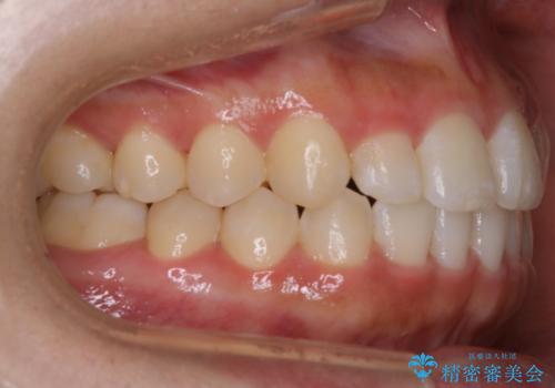 【非抜歯】部分矯正でも治る 前歯の反対咬合の治療後