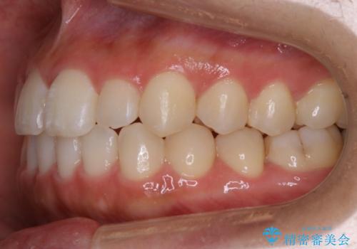 【非抜歯】部分矯正でも治る 前歯の反対咬合の治療後
