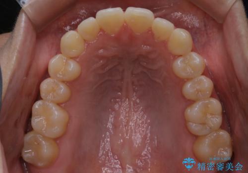 【非抜歯】部分矯正でも治る 前歯の反対咬合の治療後