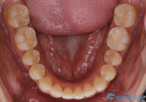 【非抜歯】部分矯正でも治る 前歯の反対咬合の治療後