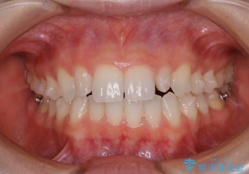下の前歯の歯石が気になる(PMTC)の治療前
