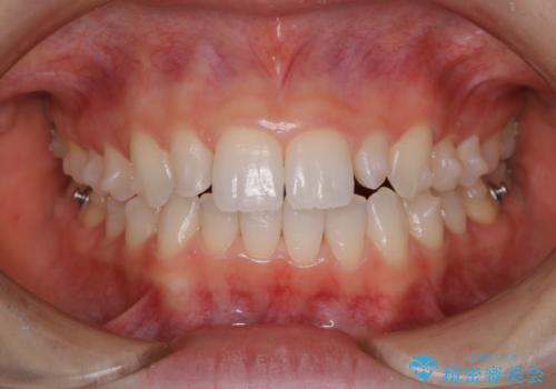 下の前歯の歯石が気になる(PMTC)の症例 治療後
