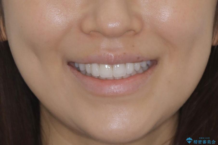 【非抜歯】噛み合わせを整えたい! インビザライン矯正の治療後(顔貌)
