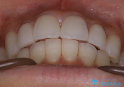 【非抜歯】噛み合わせを整えたい! インビザライン矯正の治療後