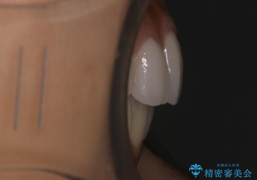 【非抜歯】噛み合わせを整えたい! インビザライン矯正の治療後