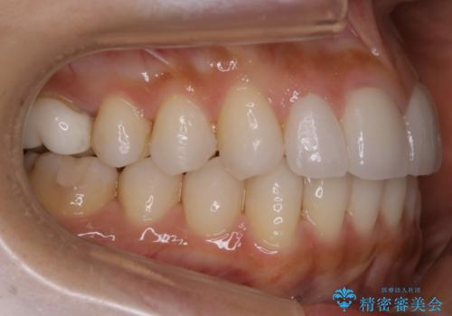 【非抜歯】噛み合わせを整えたい! インビザライン矯正の治療後