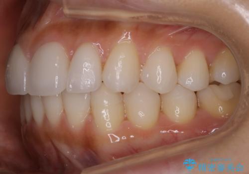 【非抜歯】噛み合わせを整えたい! インビザライン矯正の治療後