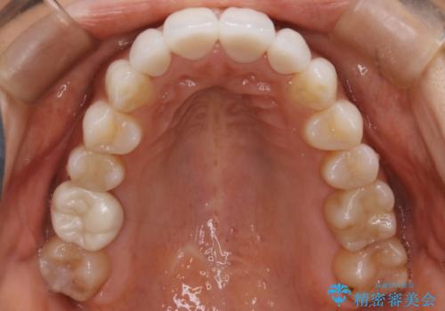 【非抜歯】噛み合わせを整えたい! インビザライン矯正の治療後