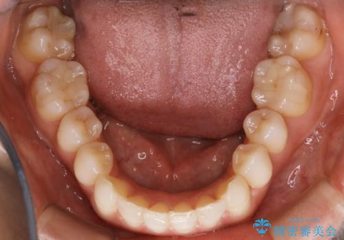 【非抜歯】噛み合わせを整えたい! インビザライン矯正の治療後