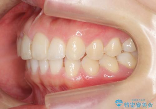 前歯のガタつきをきれいに マウスピース矯正治療の治療中