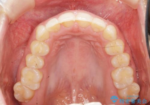 前歯のガタつきをきれいに マウスピース矯正治療の治療中