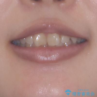 転勤予定がある インビザラインによる矯正治療の治療前(顔貌)