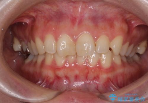 転勤予定がある インビザラインによる矯正治療の症例 治療前