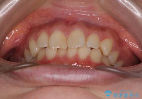 転勤予定がある インビザラインによる矯正治療の治療前