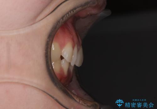 転勤予定がある インビザラインによる矯正治療の治療前