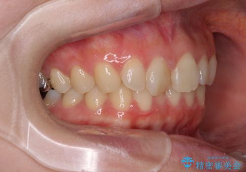 転勤予定がある インビザラインによる矯正治療の治療前