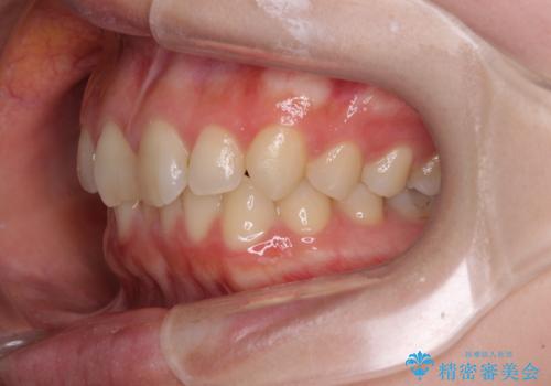 転勤予定がある インビザラインによる矯正治療の治療前