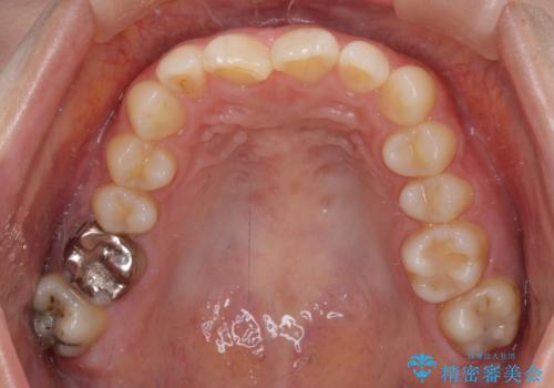 転勤予定がある インビザラインによる矯正治療の治療前