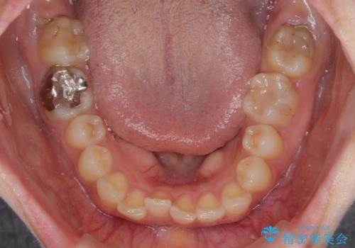 転勤予定がある インビザラインによる矯正治療の治療前