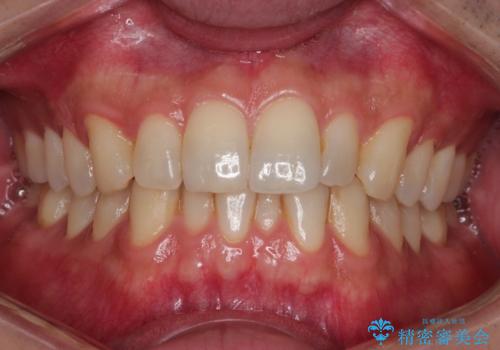 前歯のデコボコした歯並びをマウスピースで改善!の症例 治療前