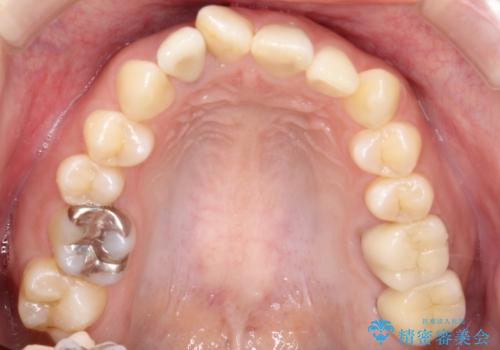 どこで咬めばいいかわからない 矯正治療で安定した咬み合わせにの治療前