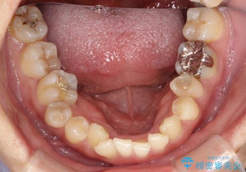 どこで咬めばいいかわからない 矯正治療で安定した咬み合わせにの治療前