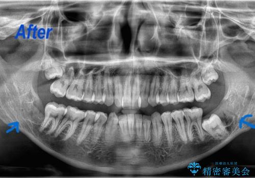 矯正前の親知らず抜歯(埋伏)の治療後