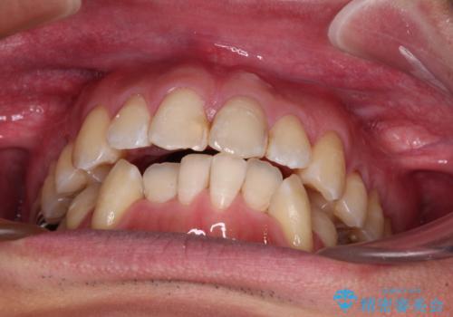 ワイヤー装置をインビザラインへ 装置変更での矯正治療の治療中