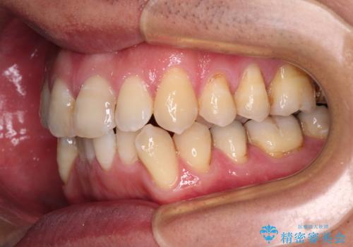 ワイヤー装置をインビザラインへ 装置変更での矯正治療の治療中