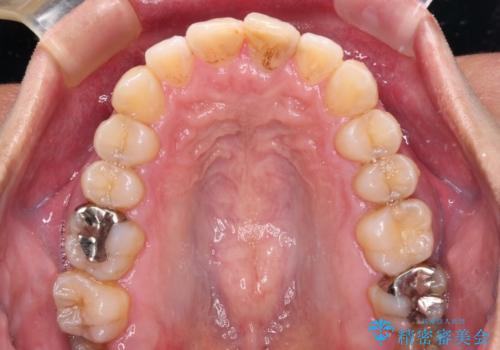 ワイヤー装置をインビザラインへ 装置変更での矯正治療の治療中