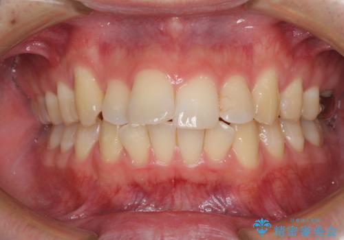 前歯のデコボコを治したい ワイヤー装置でお手軽に矯正治療の症例 治療前