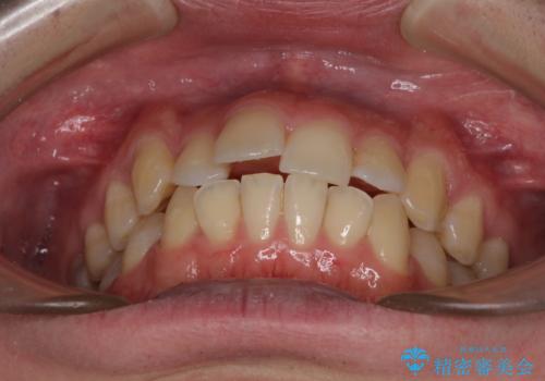 前歯のデコボコを治したい ワイヤー装置でお手軽に矯正治療の治療前