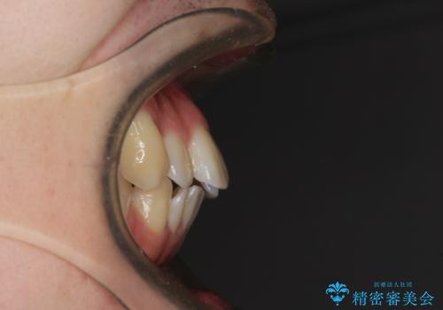 前歯のデコボコを治したい ワイヤー装置でお手軽に矯正治療の治療前