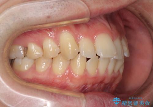 前歯のデコボコを治したい ワイヤー装置でお手軽に矯正治療の治療前