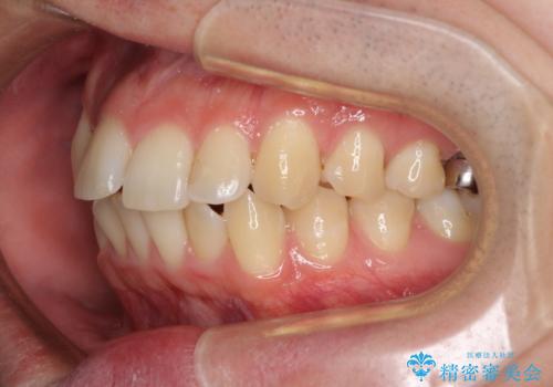 前歯のデコボコを治したい ワイヤー装置でお手軽に矯正治療の治療前