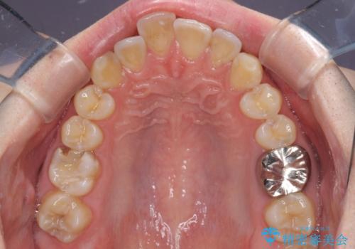 前歯のデコボコを治したい ワイヤー装置でお手軽に矯正治療の治療前