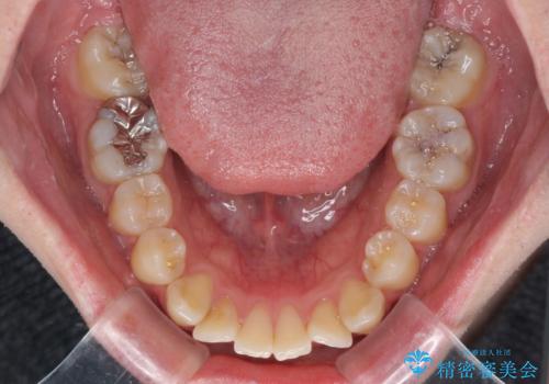 前歯のデコボコを治したい ワイヤー装置でお手軽に矯正治療の治療前