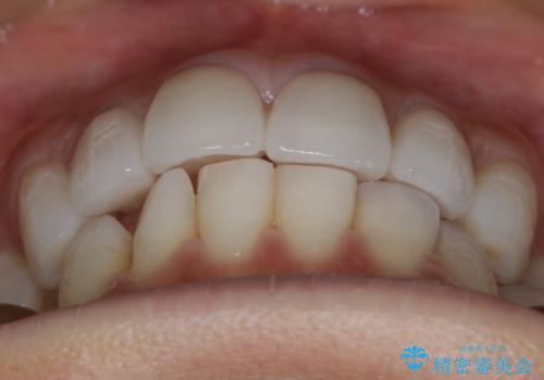 【非抜歯】噛み合わせを整えたい! インビザライン矯正の治療前
