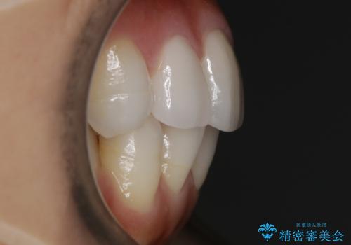 【非抜歯】噛み合わせを整えたい! インビザライン矯正の治療前
