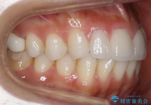 【非抜歯】噛み合わせを整えたい! インビザライン矯正の治療前