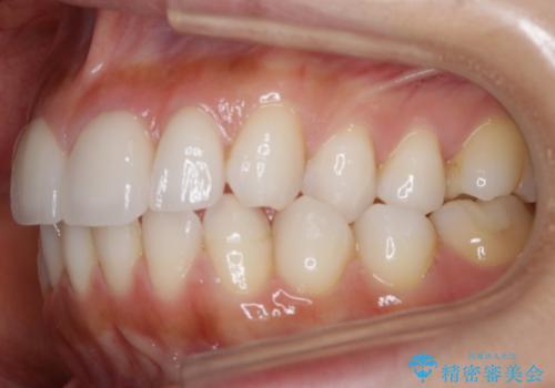 【非抜歯】噛み合わせを整えたい! インビザライン矯正の治療前
