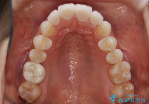 【非抜歯】噛み合わせを整えたい! インビザライン矯正の治療前