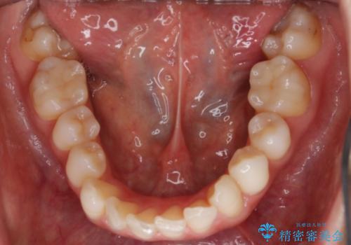 【非抜歯】噛み合わせを整えたい! インビザライン矯正の治療前