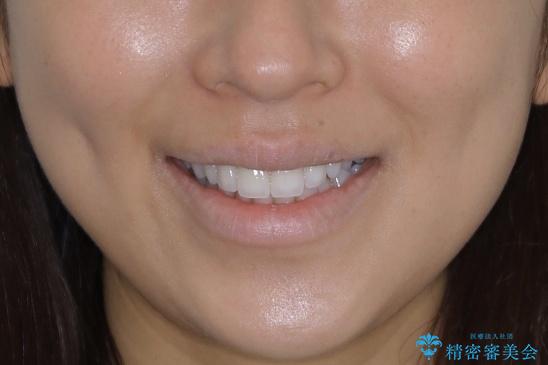 【非抜歯】噛み合わせを整えたい! インビザライン矯正の治療前(顔貌)